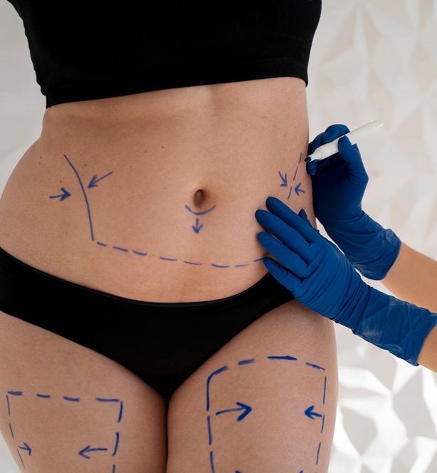 Thread Embedding Led Belly Fat Reduction
